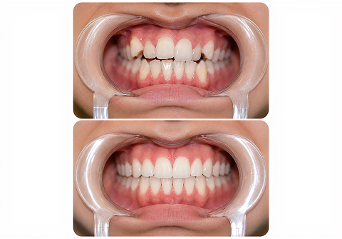 Crowded teeth Before and After