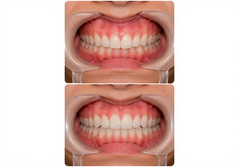 Deep bites Before and After