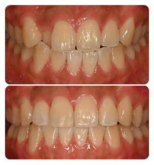 Crossbites Before and After