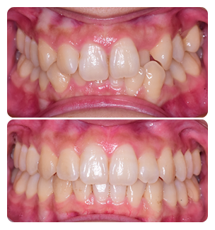 Crowded teeth Before and After