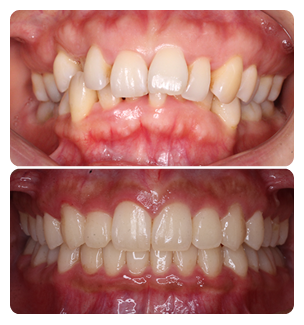 Deep bites Before and After