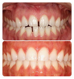Gaps between teeth Before and After