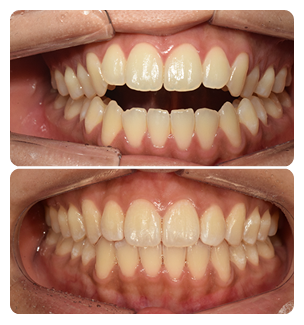 Open Bite Before and After