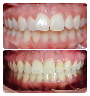 Overbites Before and After